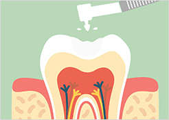 むし歯治療4