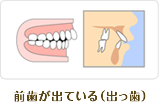 前歯が出ている（出っ歯）