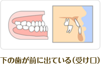 下の歯が前に出ている（受け口）