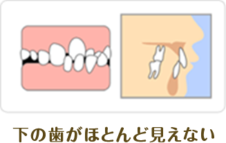 下の歯がほとんど見えない